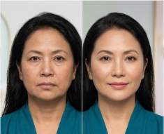 Facelift result KOQ10