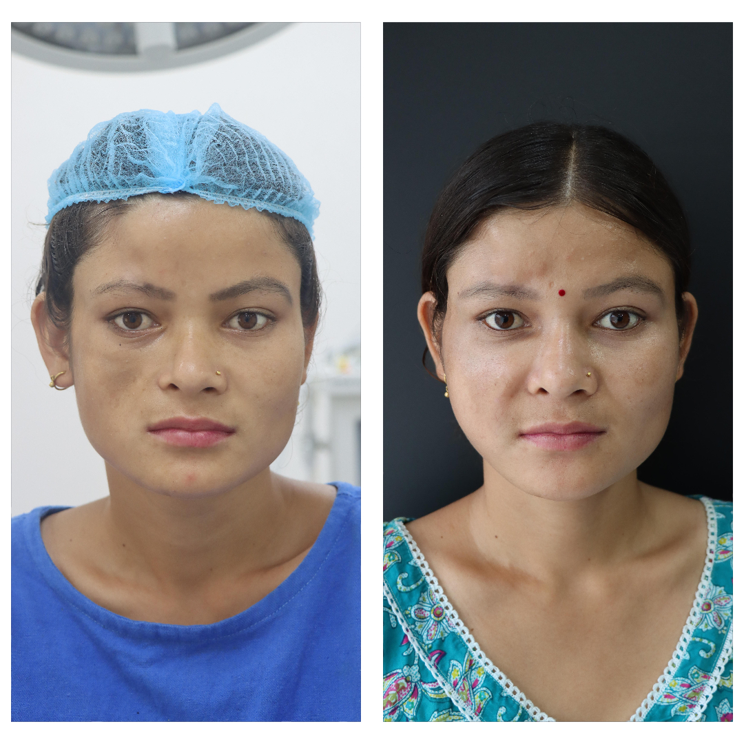 Fat Grafting result KOQ10