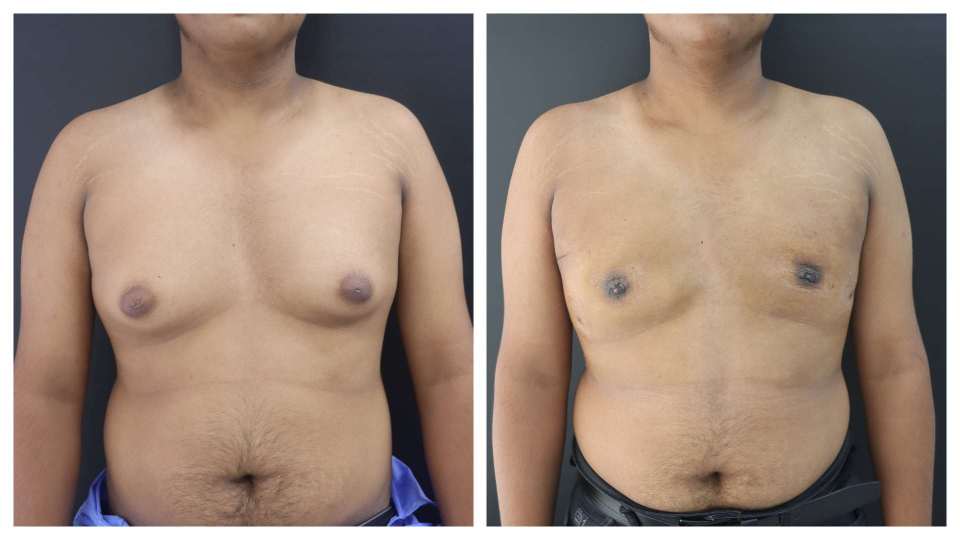 Gynaecomastia result KOQ10