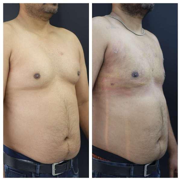 Gynaecomastia result KOQ10