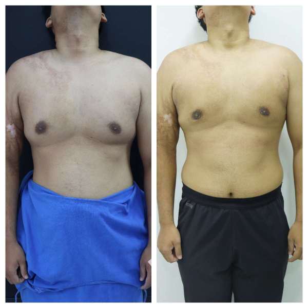 Gynaecomastia result KOQ10