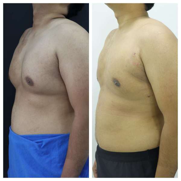 Gynaecomastia result KOQ10
