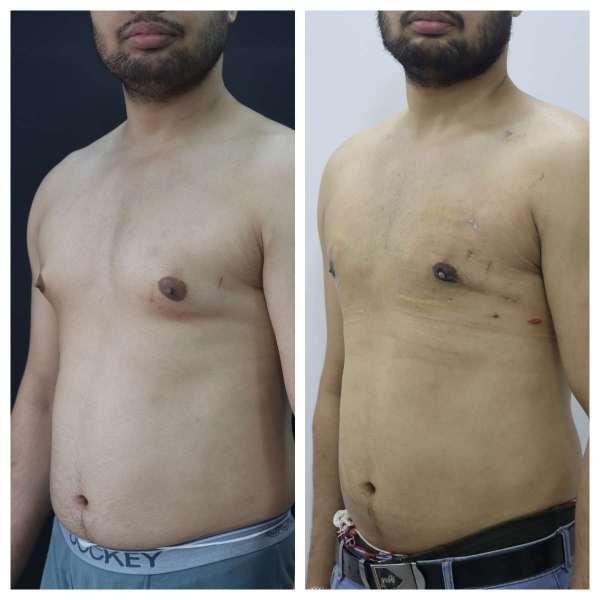 Gynaecomastia result KOQ10