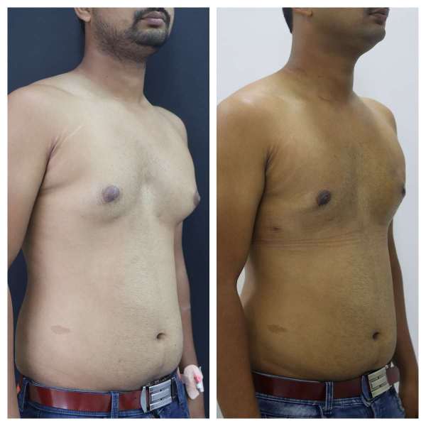 Gynaecomastia result KOQ10