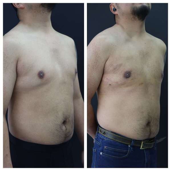 Gynaecomastia result KOQ10