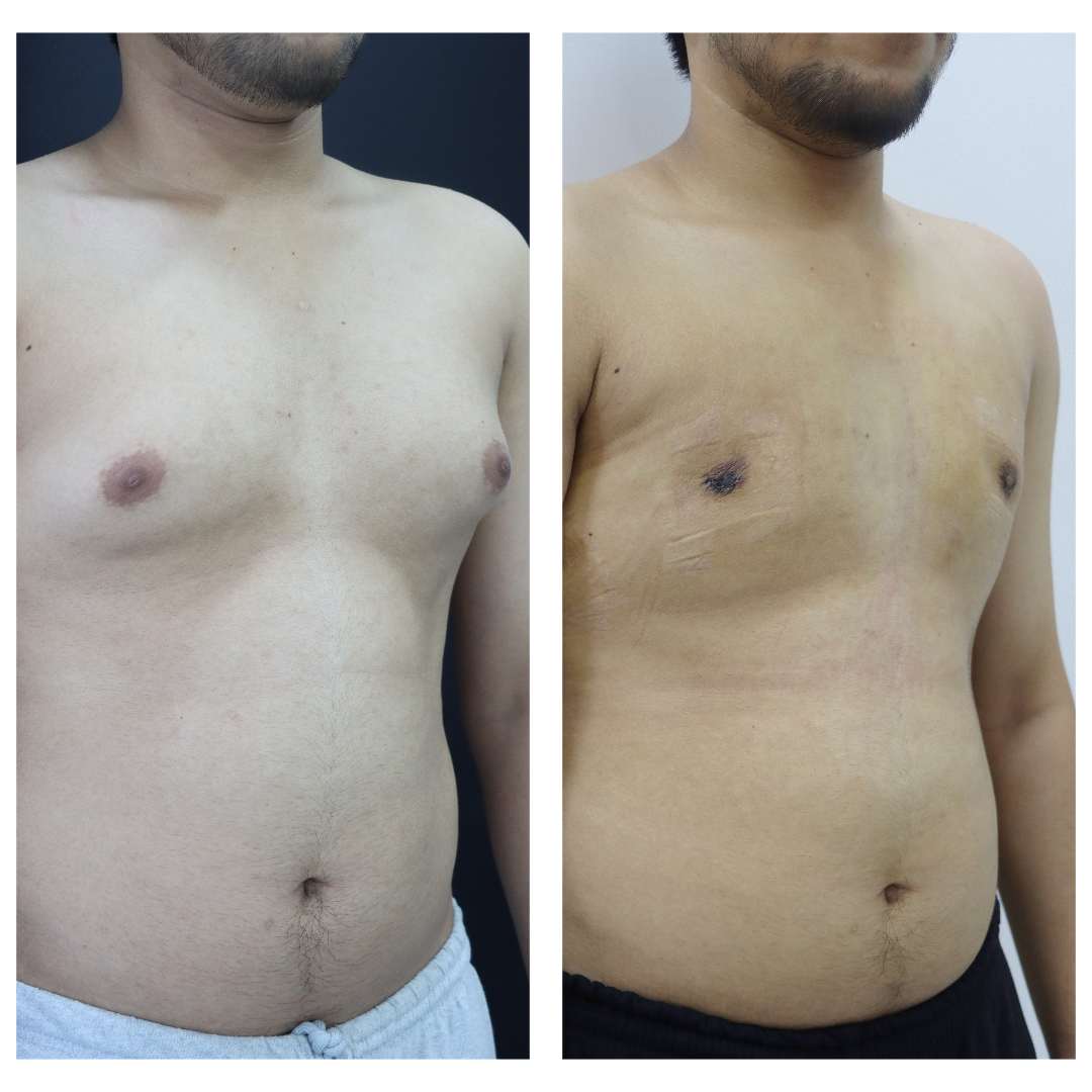 Gynaecomastia result KOQ10