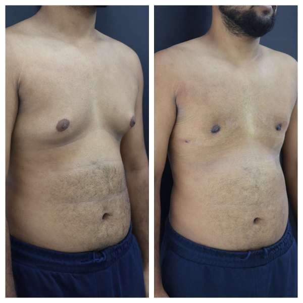 Gynaecomastia result KOQ10