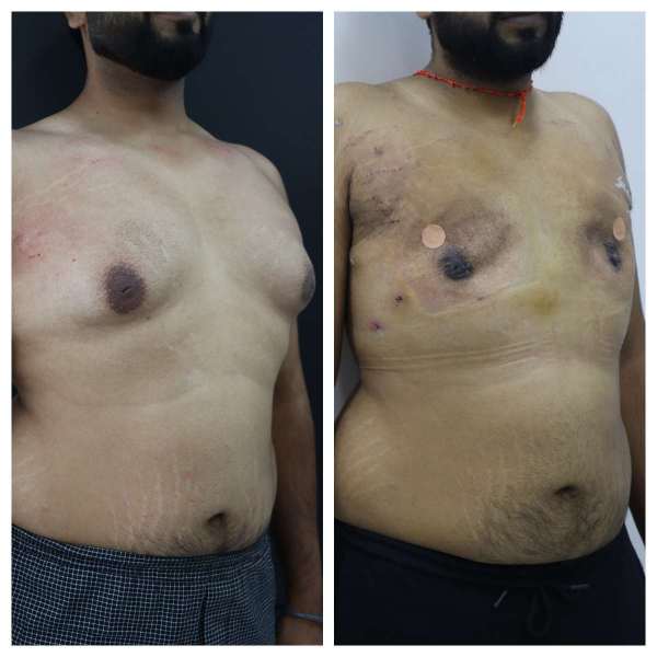 Gynaecomastia result KOQ10