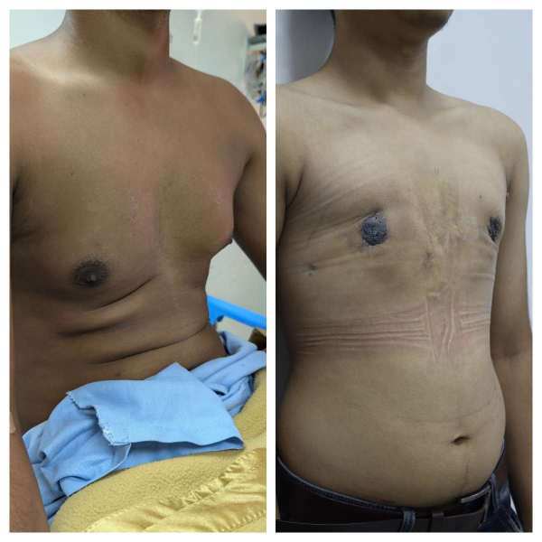 Gynaecomastia result KOQ10
