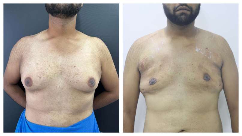 Gynaecomastia result KOQ10