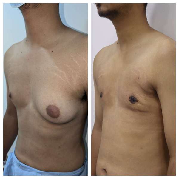 Gynaecomastia result KOQ10