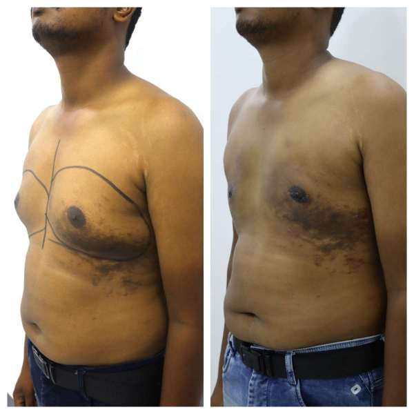Gynaecomastia result KOQ10