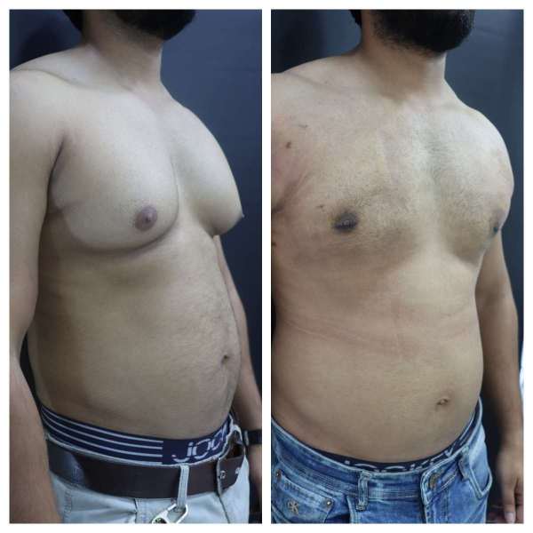 Gynaecomastia result KOQ10