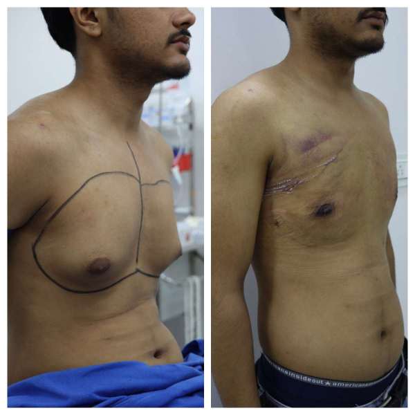 Gynaecomastia result KOQ10