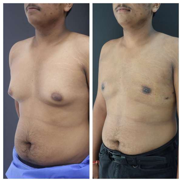 Gynaecomastia result KOQ10