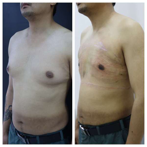 Gynaecomastia result KOQ10