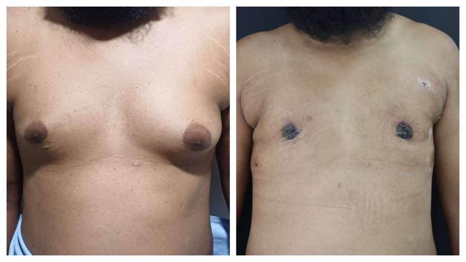 Gynaecomastia result KOQ10