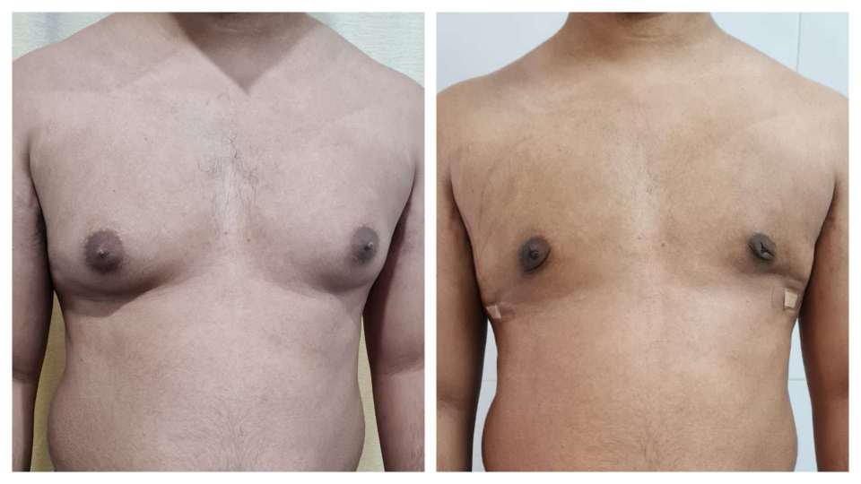 Gynaecomastia result KOQ10