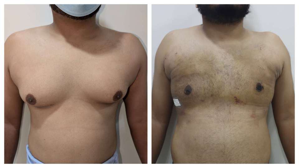 Gynaecomastia result KOQ10