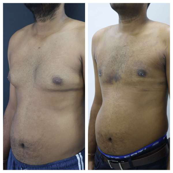 Gynaecomastia result KOQ10