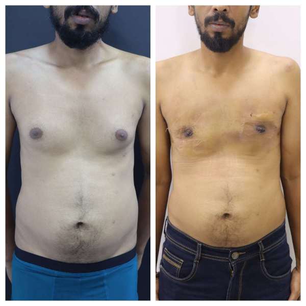 Gynaecomastia result KOQ10