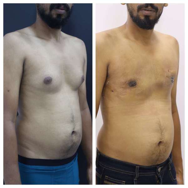 Gynaecomastia result KOQ10