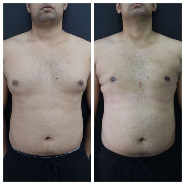Gynaecomastia result KOQ10
