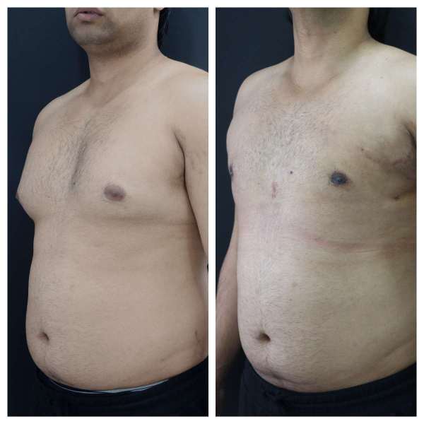 Gynaecomastia result KOQ10