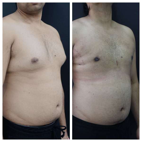 Gynaecomastia result KOQ10
