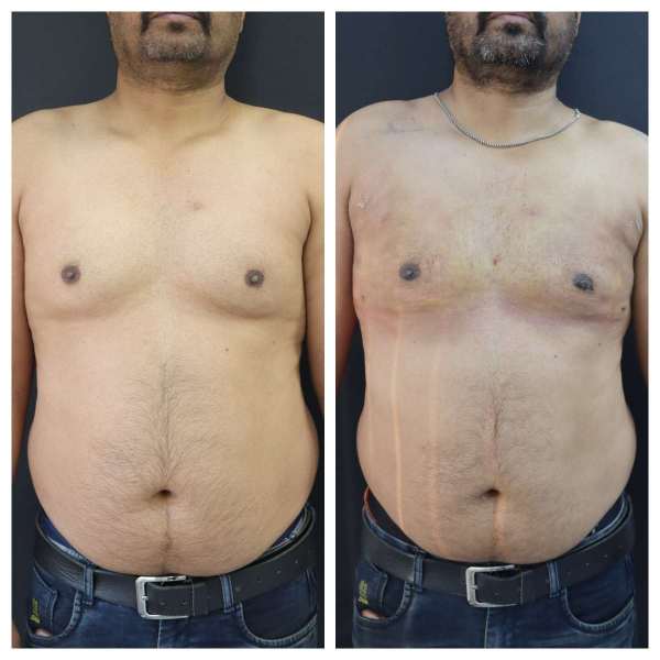 Gynaecomastia result KOQ10