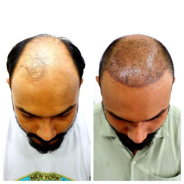 Hair Transplant result KOQ10