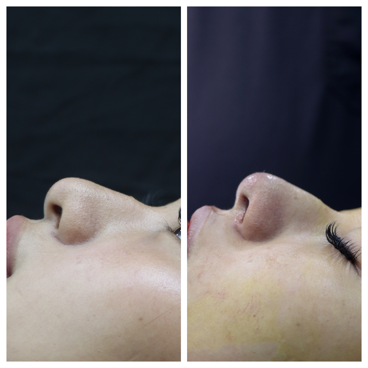 Hanging Columella result KOQ10