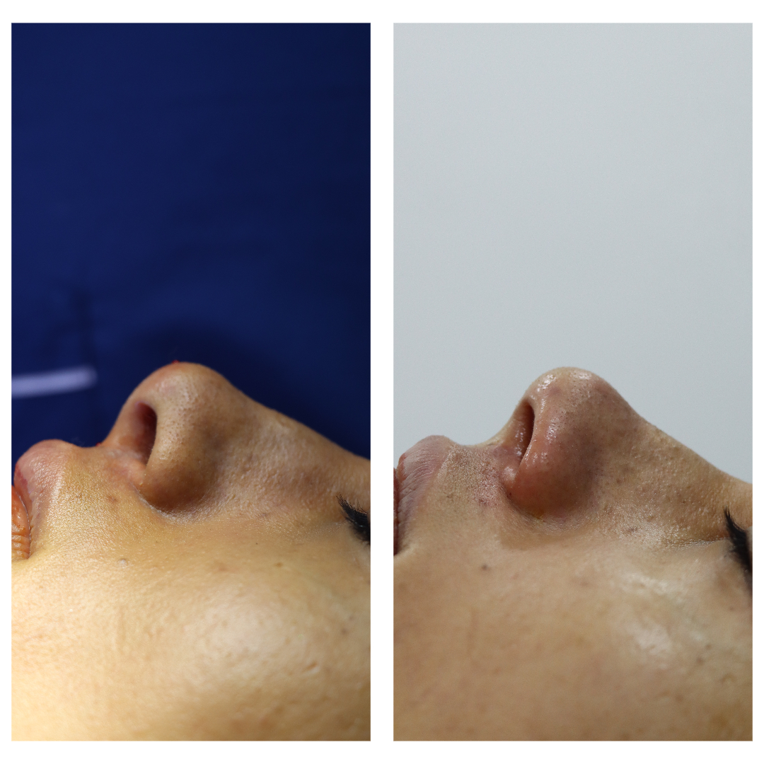 Columella Nose Surgery KOQ10