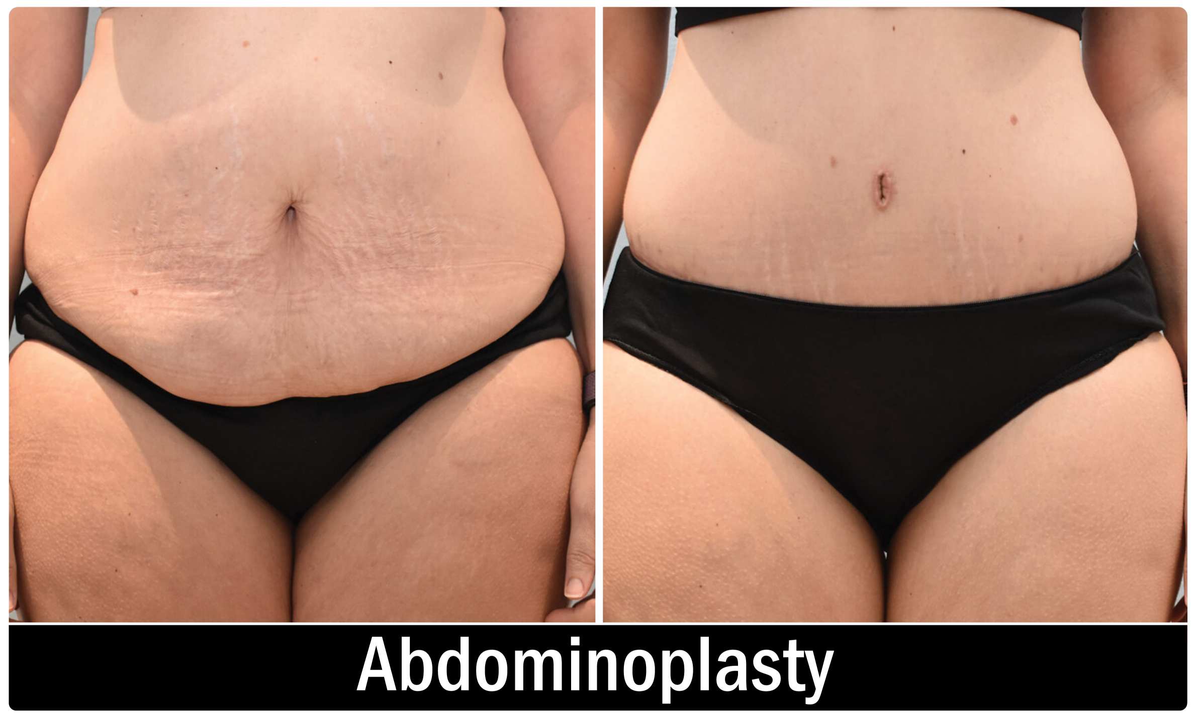 Breast Implant result KOQ10