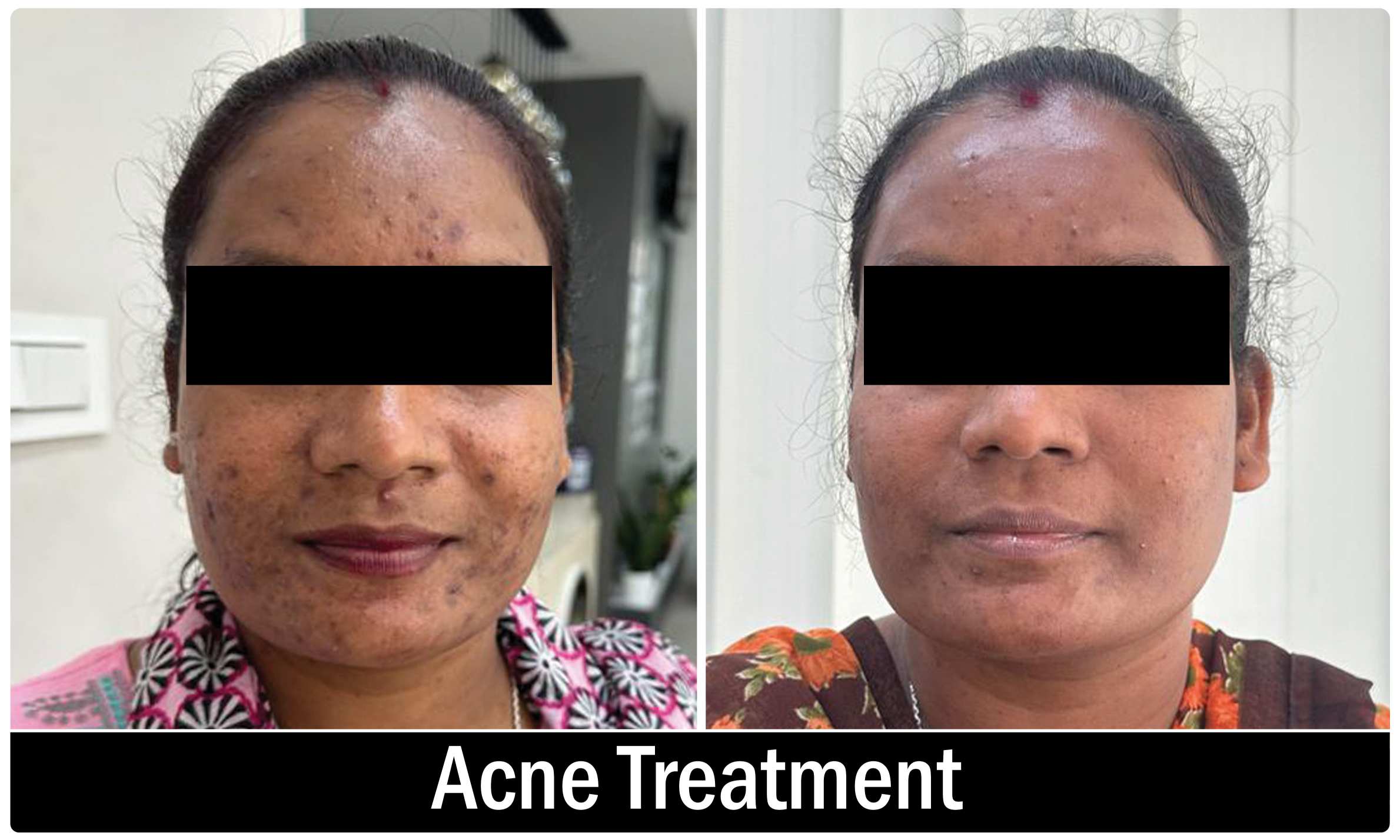 Breast Reduction result KOQ10