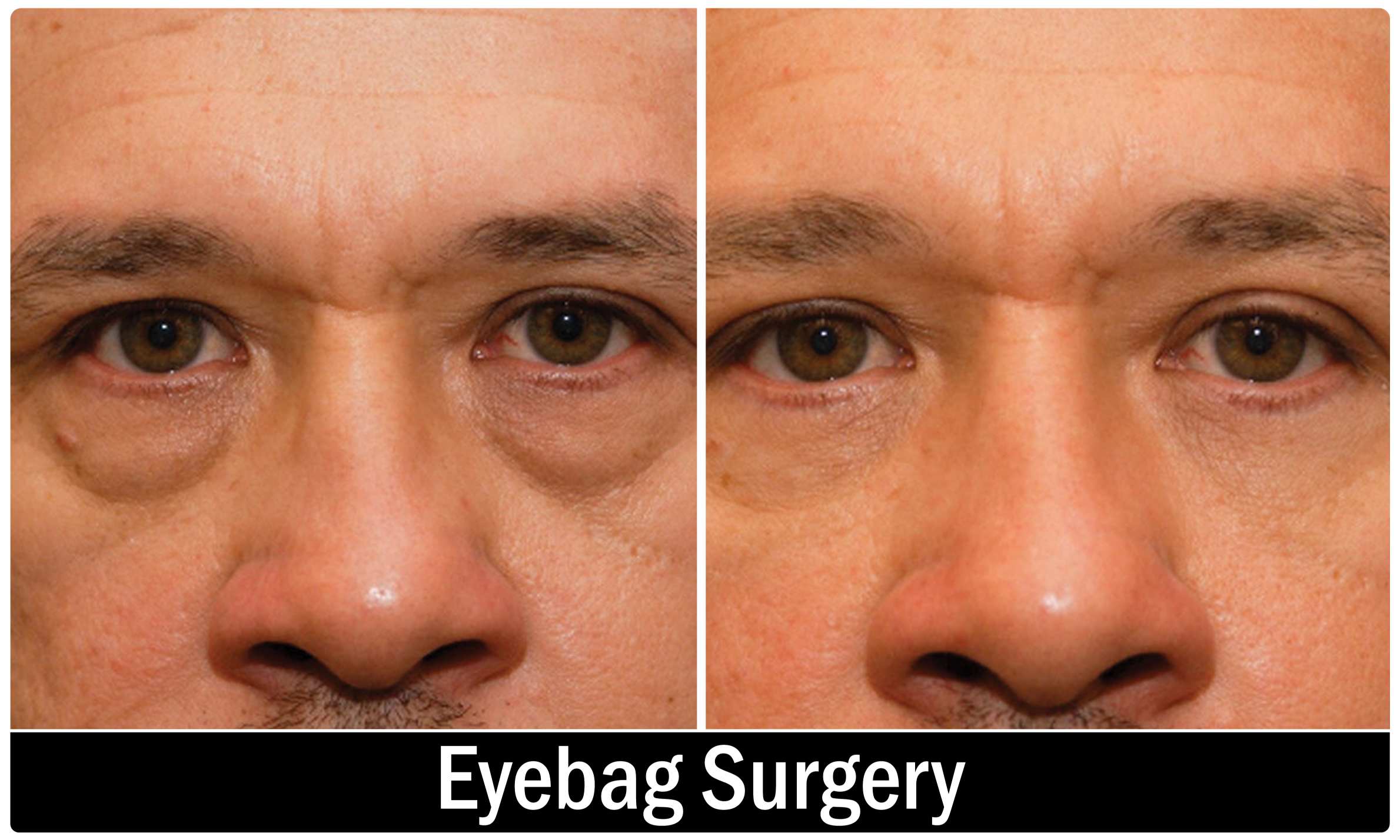 Eye bag Surgery KOQ10