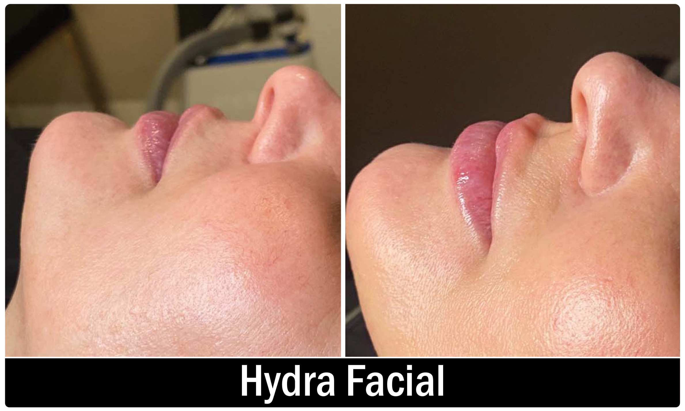 Hyfrafacial transplant KOQ10