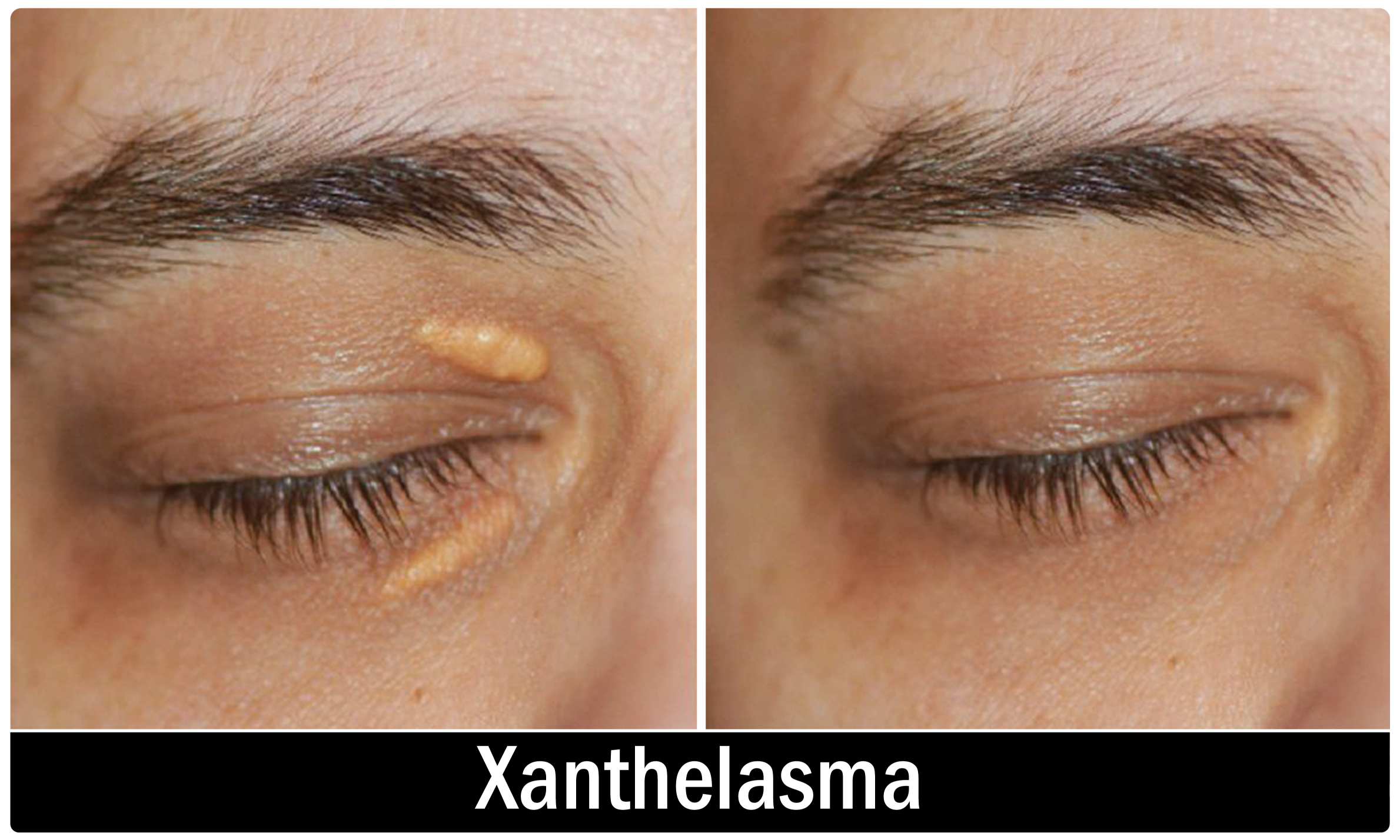 Xanthelasma Removal KOQ10